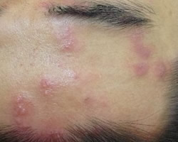 Shingles Treatment